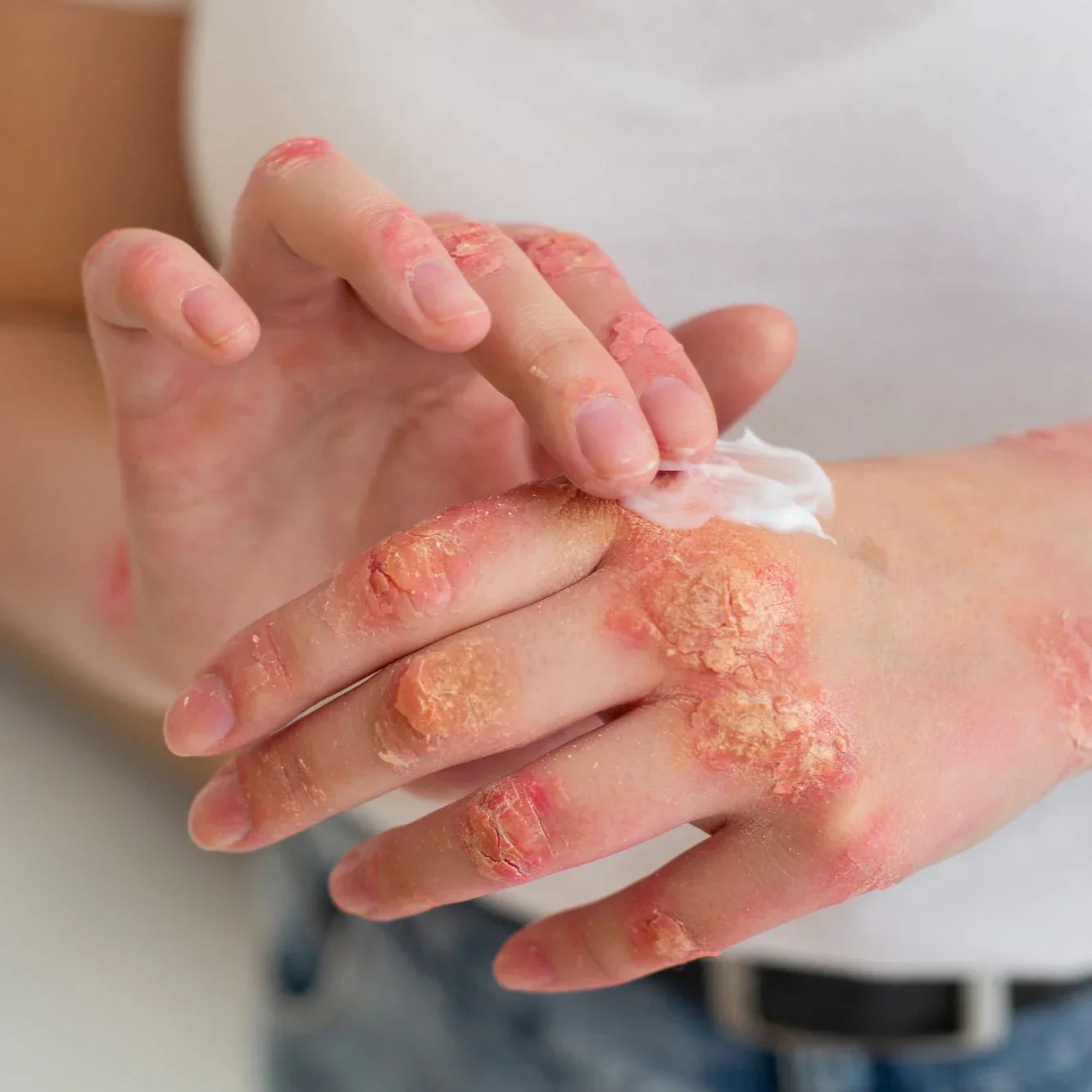 Understanding Psoriasis: Pathogenesis, Mechanisms, and Evidence-Based Treatments