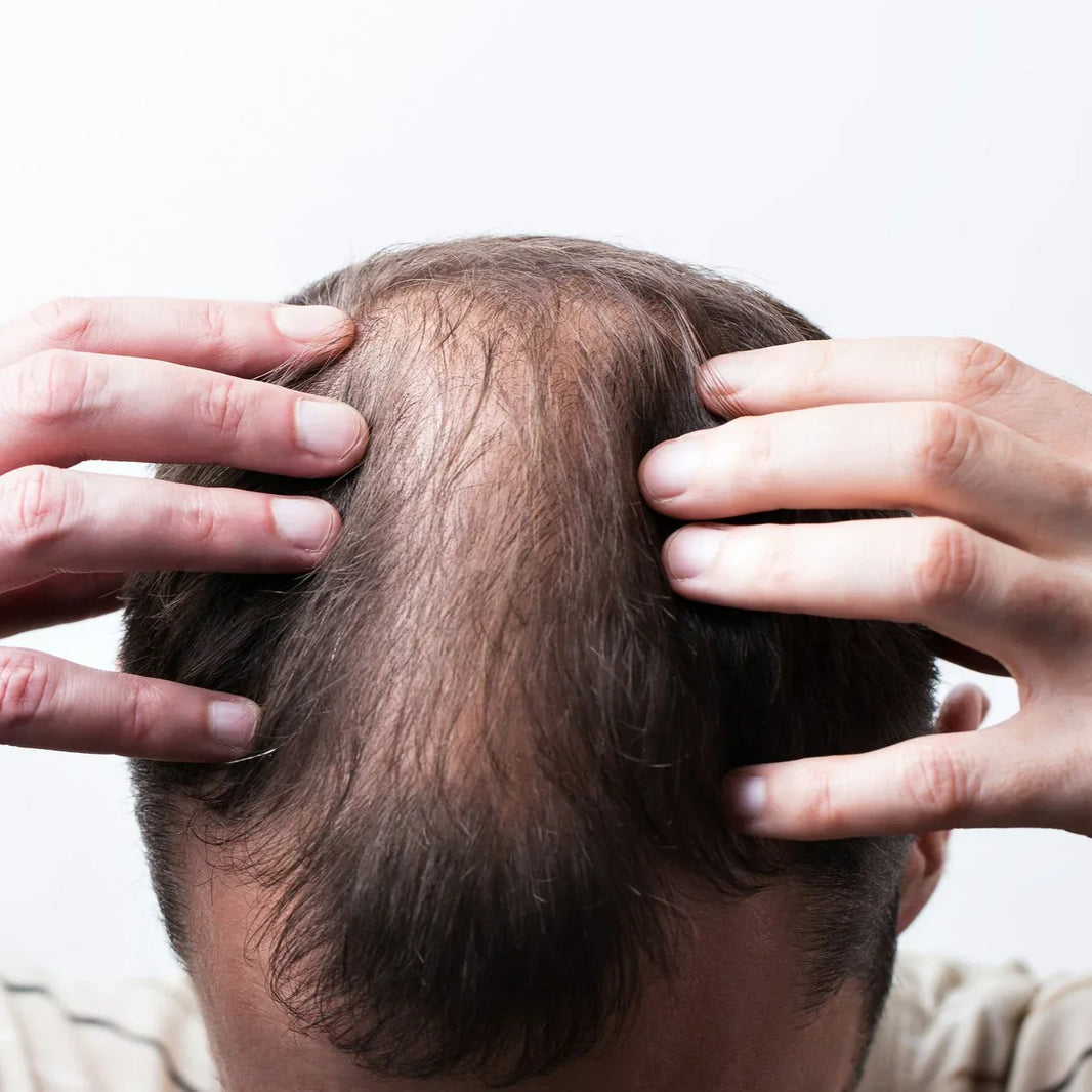 Alopecia: Mechanisms, Pathways, and Treatment Efficacy Analysis