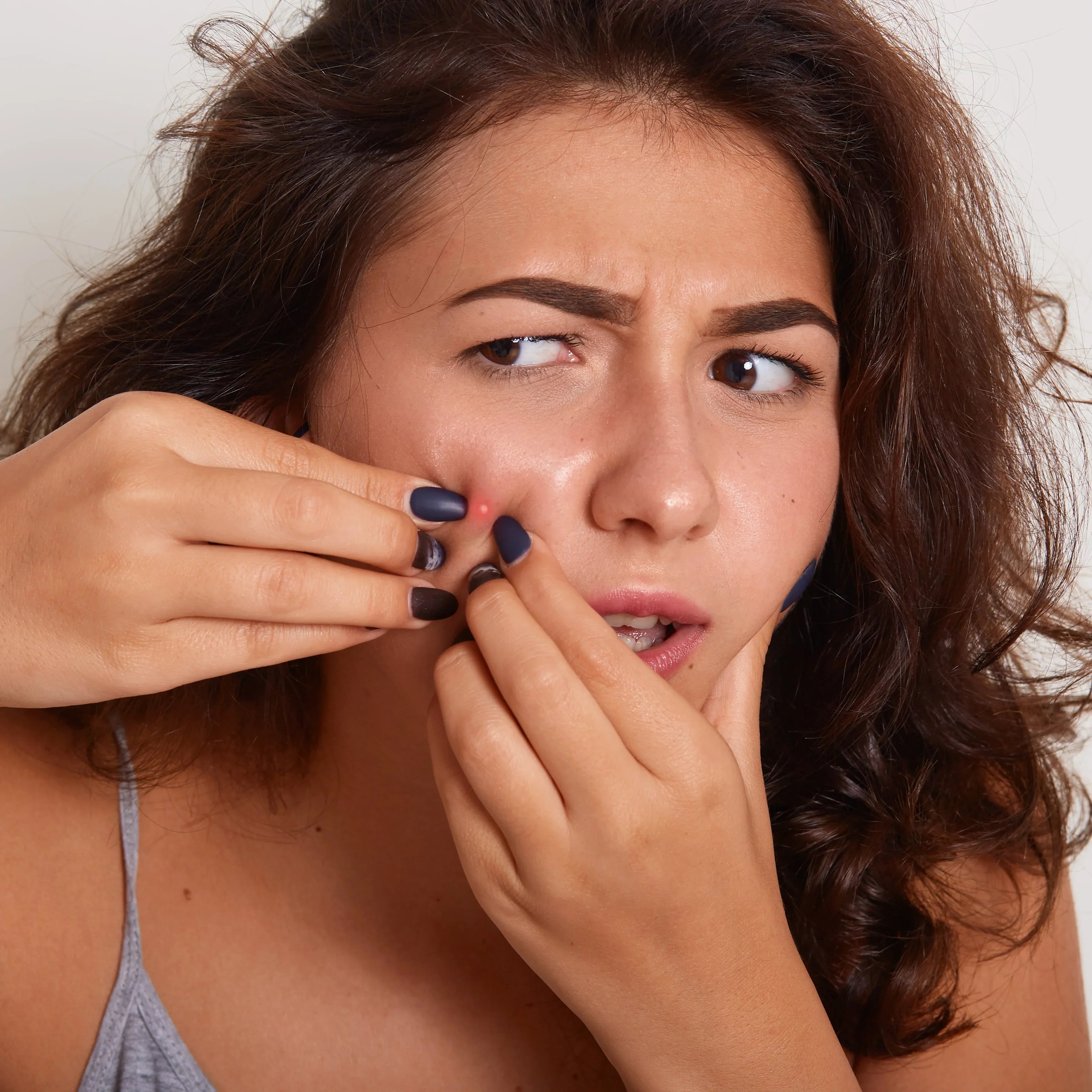 Acne Vulgaris: Pathophysiological Mechanisms and Therapeutic Role of Nutritional Supplements